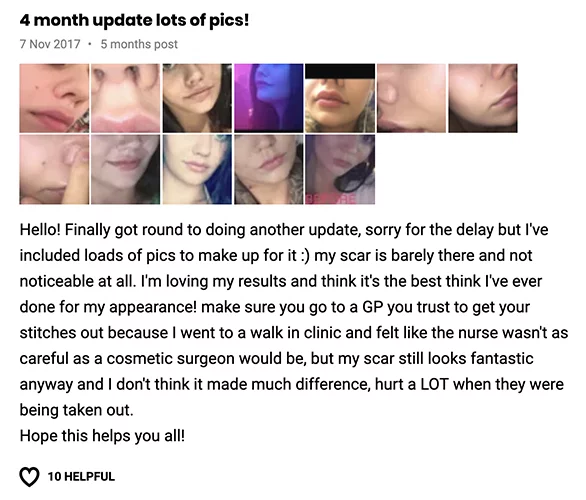 Lip lift klinika doktor Osuch opinie