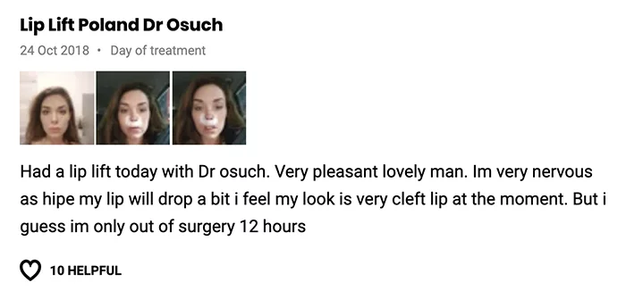 Lip lift klinika doktor Osuch opinie