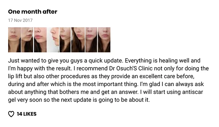 Lip lift klinika doktor Osuch opinie