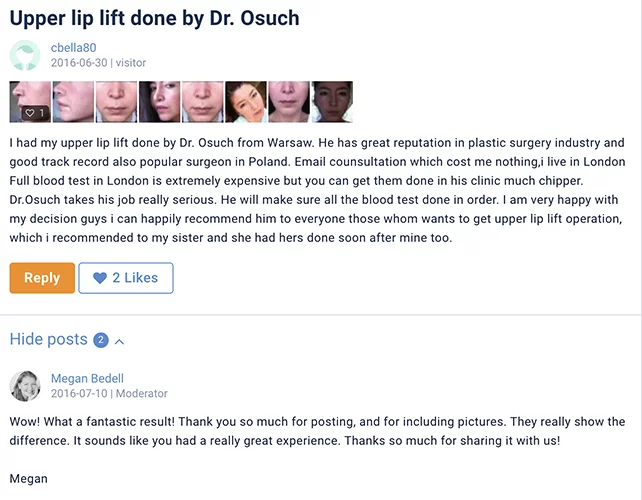 Lip lift klinika doktor Osuch opinie